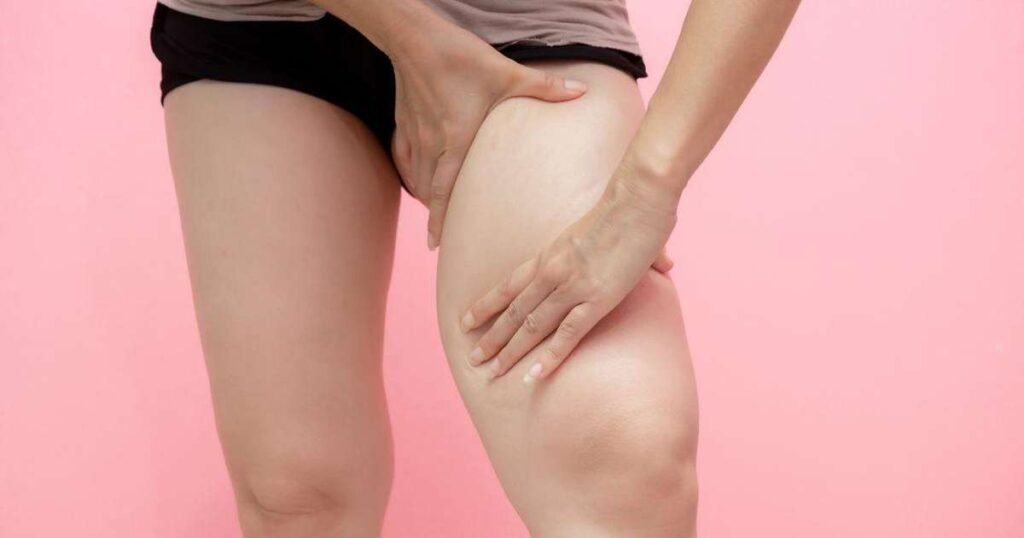 Mulher praticando hidroginástica como parte do tratamento do lipedema