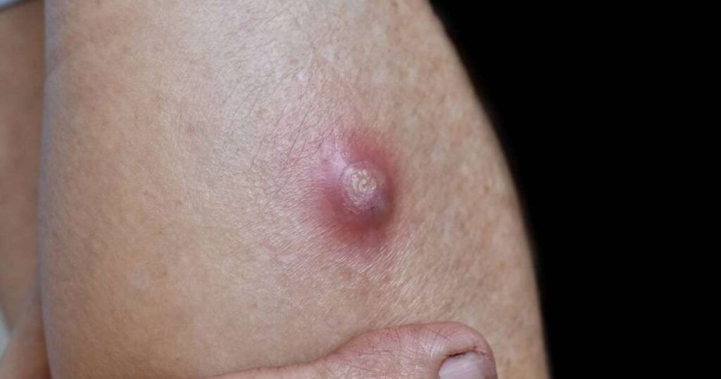 Ilustração de um furúnculo na pele mostrando os sintomas e áreas afetadas.