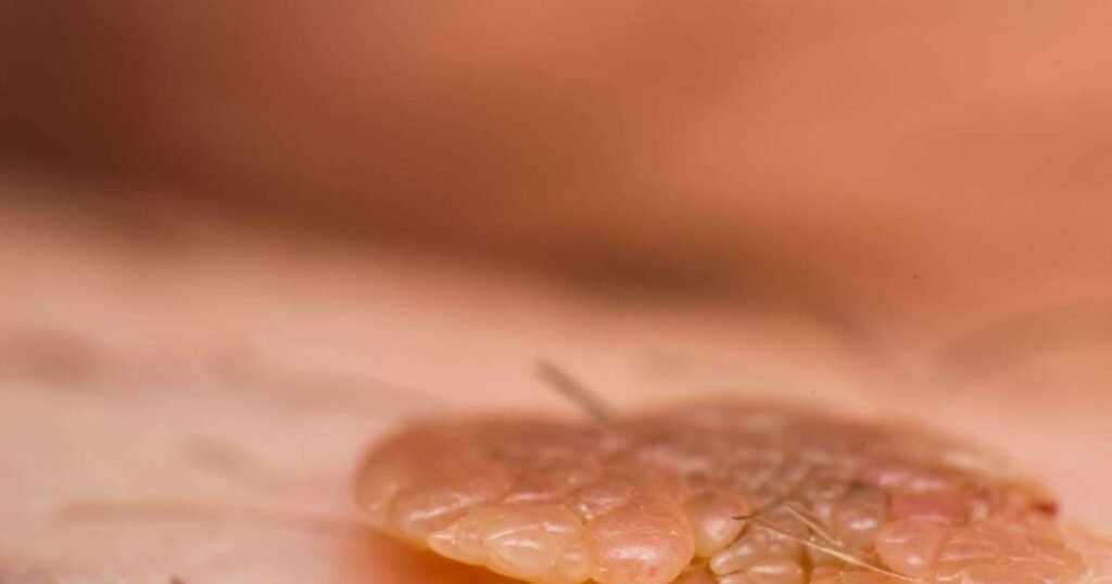 Representação gráfica do Papilomavírus Humano (HPV) mostrando suas categorias de risco e formas de prevenção.