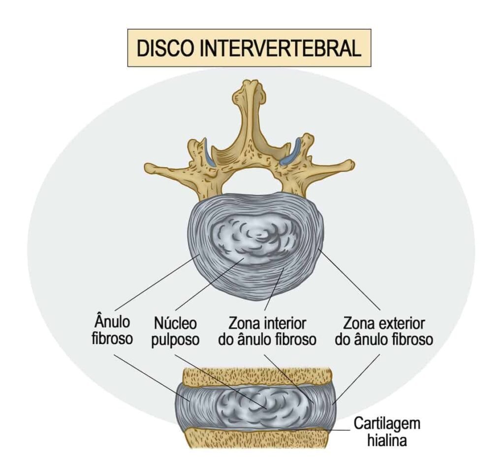 Disco intervertebral saudável e degenerado com destaque para as alterações causadas pelo tabagismo